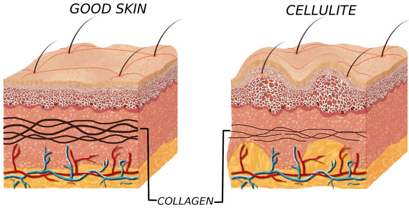 Cellulite collagene