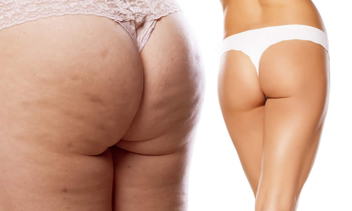 cellulite crolipolisi
