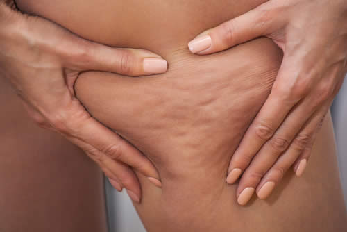 cellulite edematosa