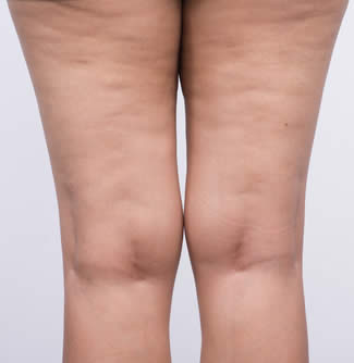cellulite fibrosa