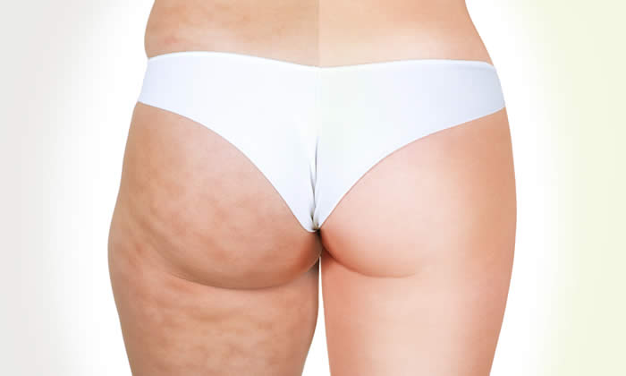 cellulite- fotoritoccata
