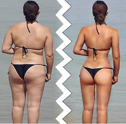 cellulite fotoritocco