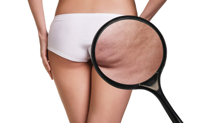 Cellulite Ingrandimento