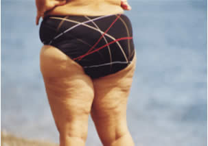 Cellulite irreversibile