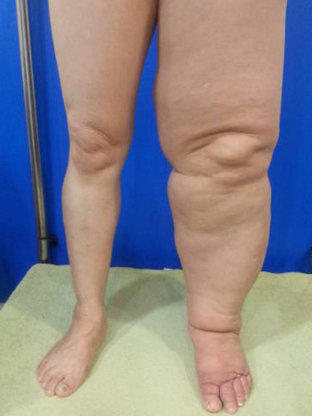 cellulite linfoedematosa