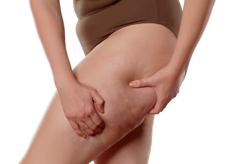 Evoluzione della Cellulite - Scopri il Tuo Stadio e Se Puoi Migliorare