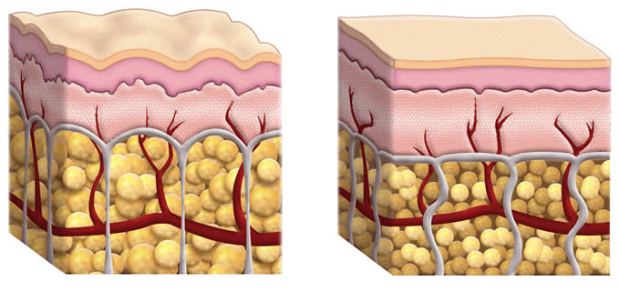 Cellulite Pelle