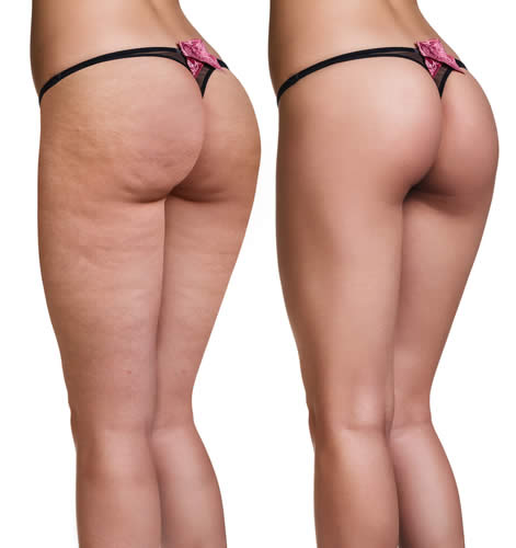 cellulite photoshop