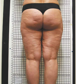 Cellulite Sclerotica Flaccida