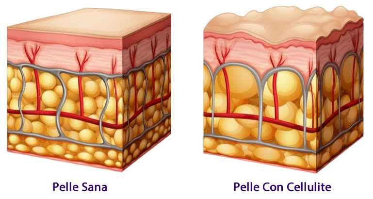 Cause Cellulite - Spiegate Bene | Cos'è la Cellulite? Perché si Forma?