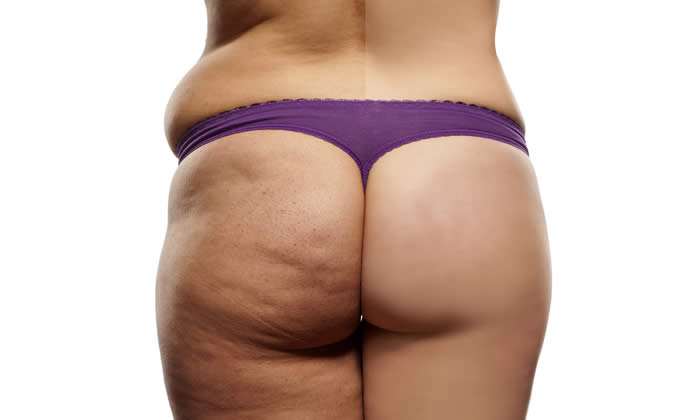 liposuzione cellulite