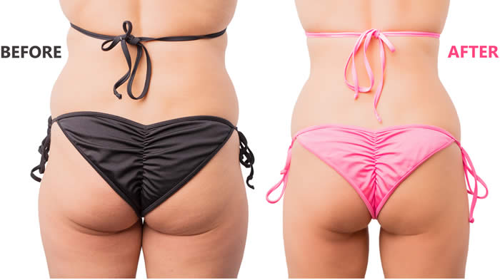 Liposuzione risultati prima e dopo