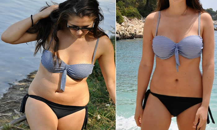 Liposuzione Prima e Dopo