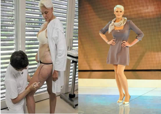 nielsen cellulite