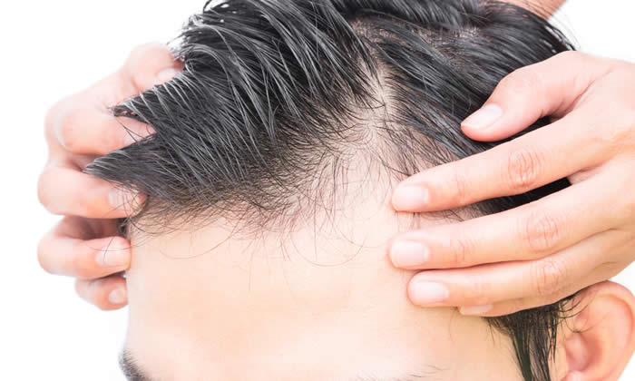 Alopecia 2019 - Che cos'è? Tipi di Alopecia e Sintomi