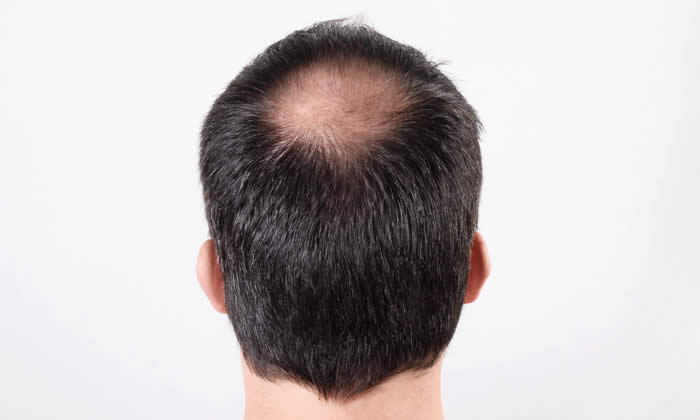 Alopecia Androgenetica