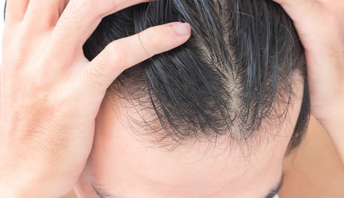 Alopecia Androgenetica 2019 - Cause, Farmaci e Cure Efficaci