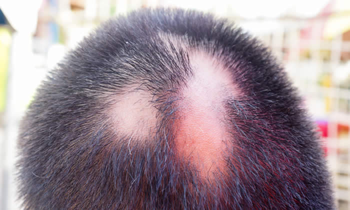 Alopecia Areata