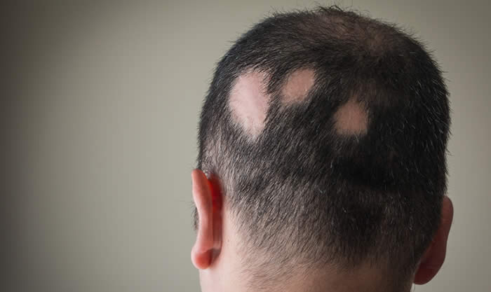 Alopecia Areata 2019 - Cause, Sintomi e Cure Efficaci