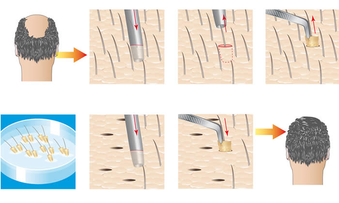 Tecnica FUE - Trapianto Capelli 2019 - Vantaggi, Svantaggi, Esecuzione