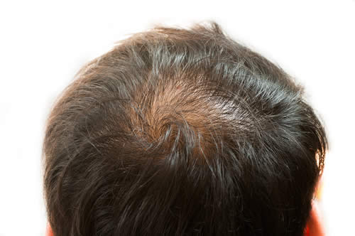 Chierica Alopecia