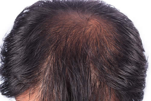Alopecia vertice leggera