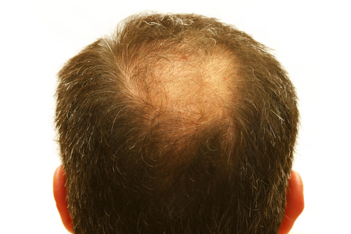 Minoxidil