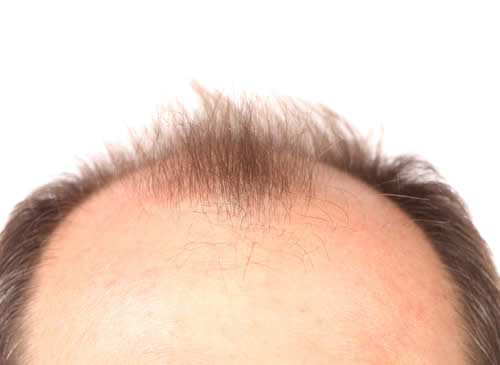 Minoxidil inefficace