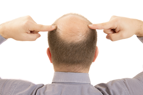 Minoxidil non funziona