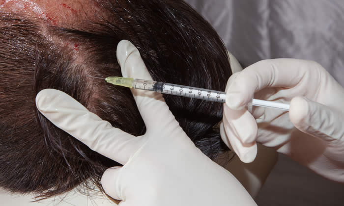 Trattamento PRP 2019 - Plasma Ricco di Piastrine e Capelli: Funziona?