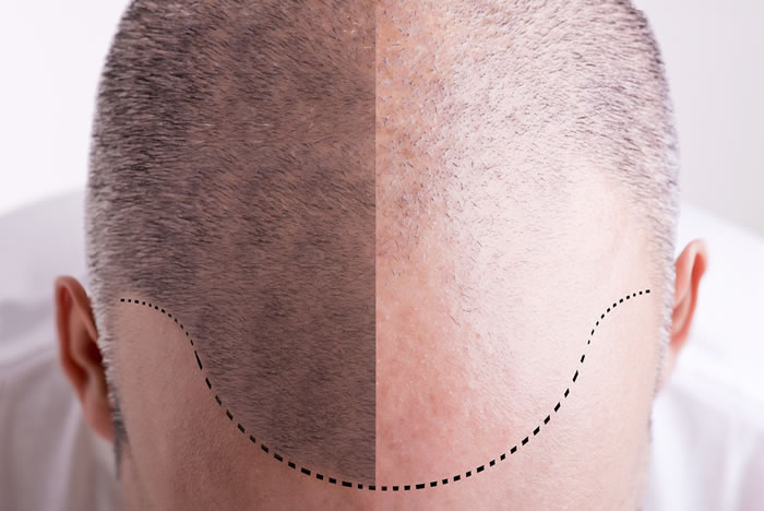 Trapianto di Capelli 2019 - Funziona? Prezzo, Risultati, Effetti Collaterali