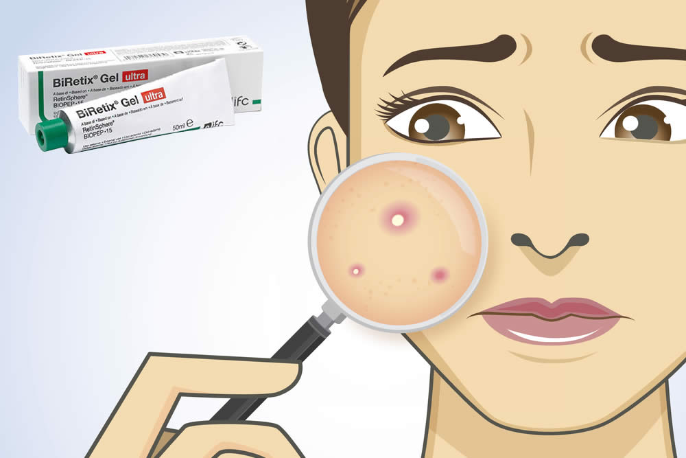 Biretix Gel Ultra 2019 - Contro Acne e Comedoni: Funziona? Opinioni
