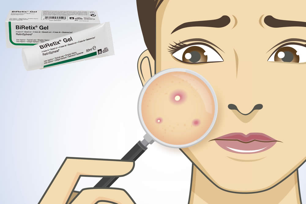 Biretix Gel 2019 - Funziona Contro l'Acne? Benefici, Prezzo e Opinioni