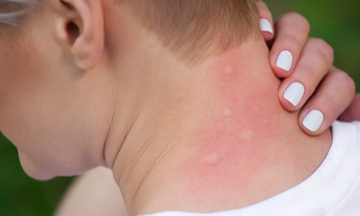 Punture d'Insetto? Oli Essenziali contro Prurito e Rossore