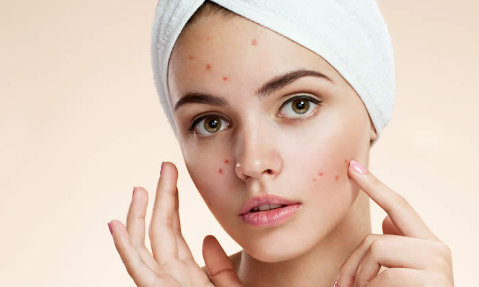 Cura Acne - Oli Essenziali per Alleviare il Disturbo