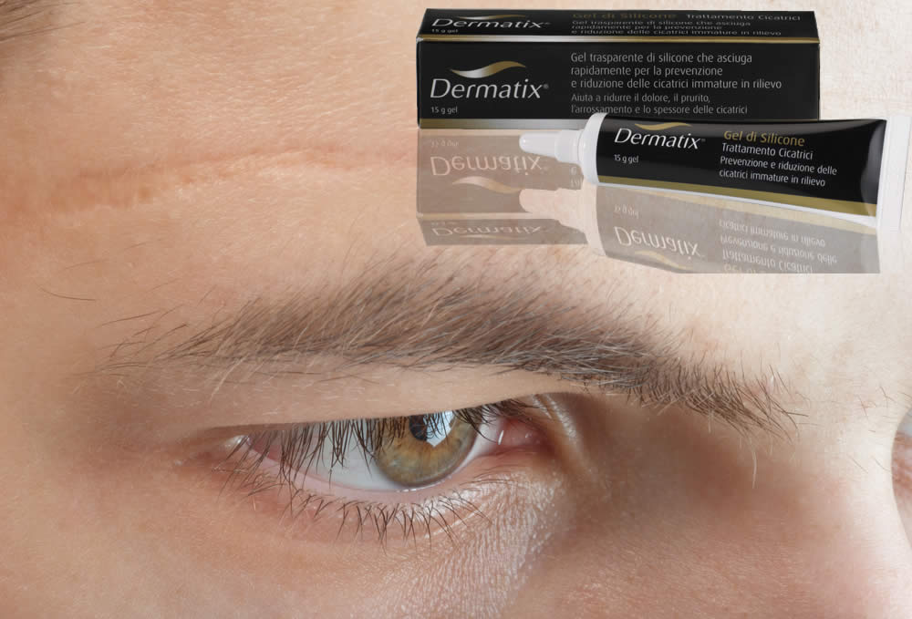 Dermatix Gel - Funziona Contro le Cicatrici? Recensione 2019