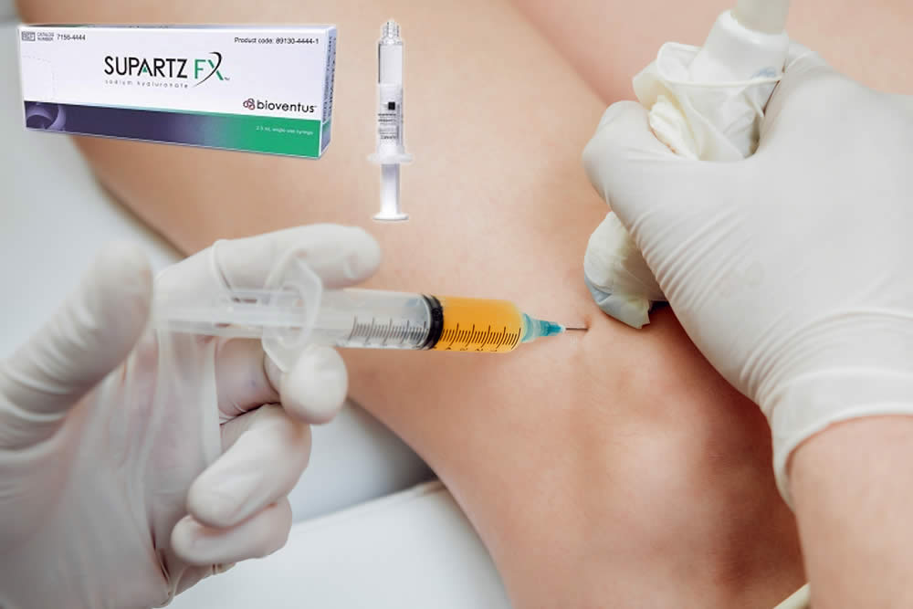 Supartz 2019. Benefici, Opinioni. Infiltrazioni Acido Ialuronico Artrosi