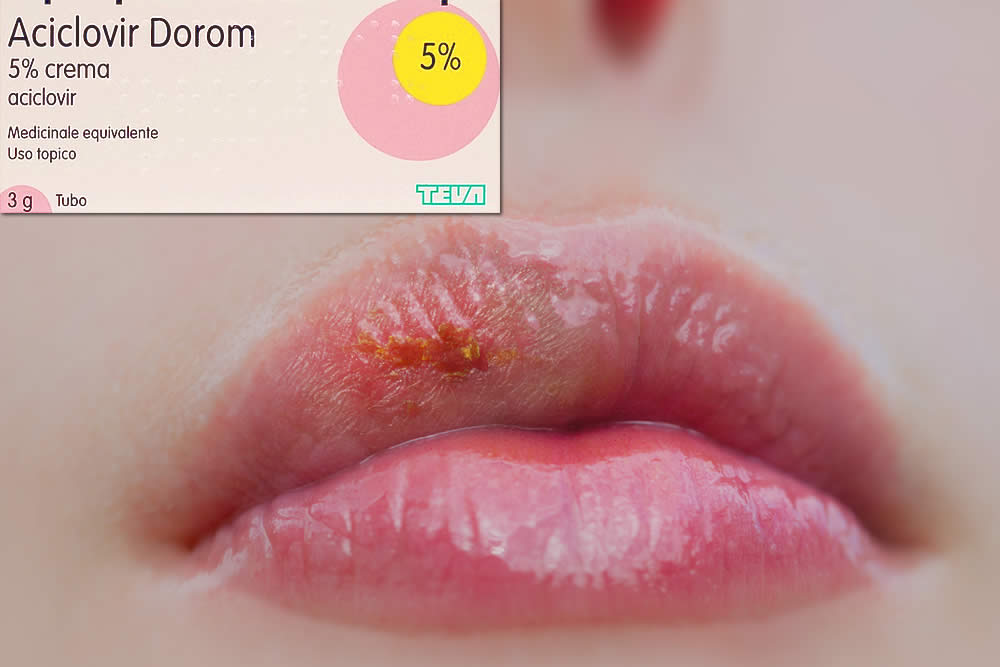 Aciclovir Dorom 5% Crema - Foglio Illustrativo 2019 Spiegato -