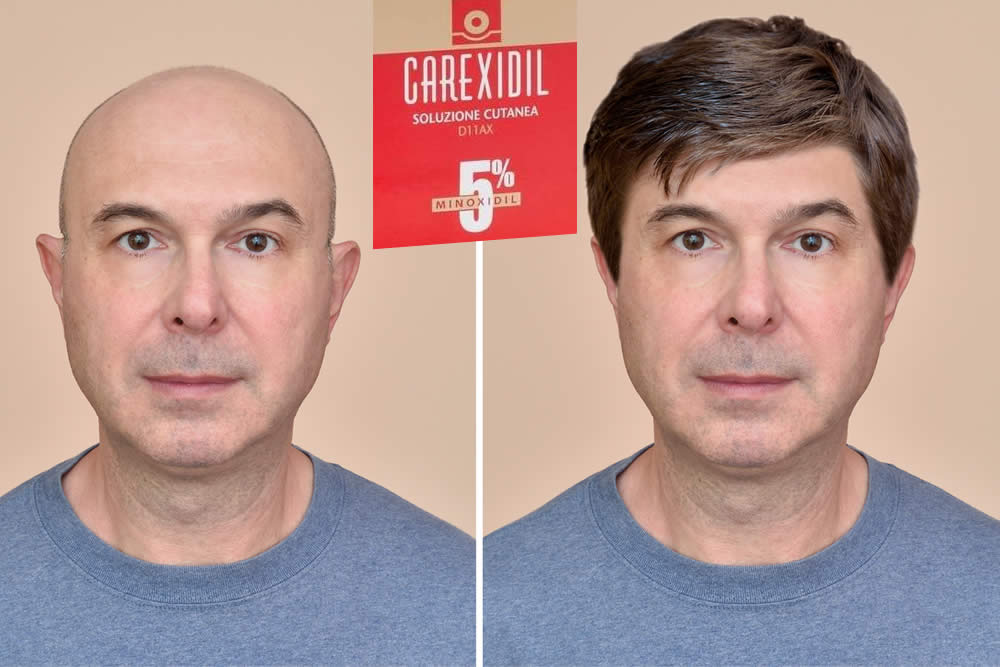 Carexidil 2019 - Spiegato Bene - Uso, Prezzo e Foglietto Illustrativo