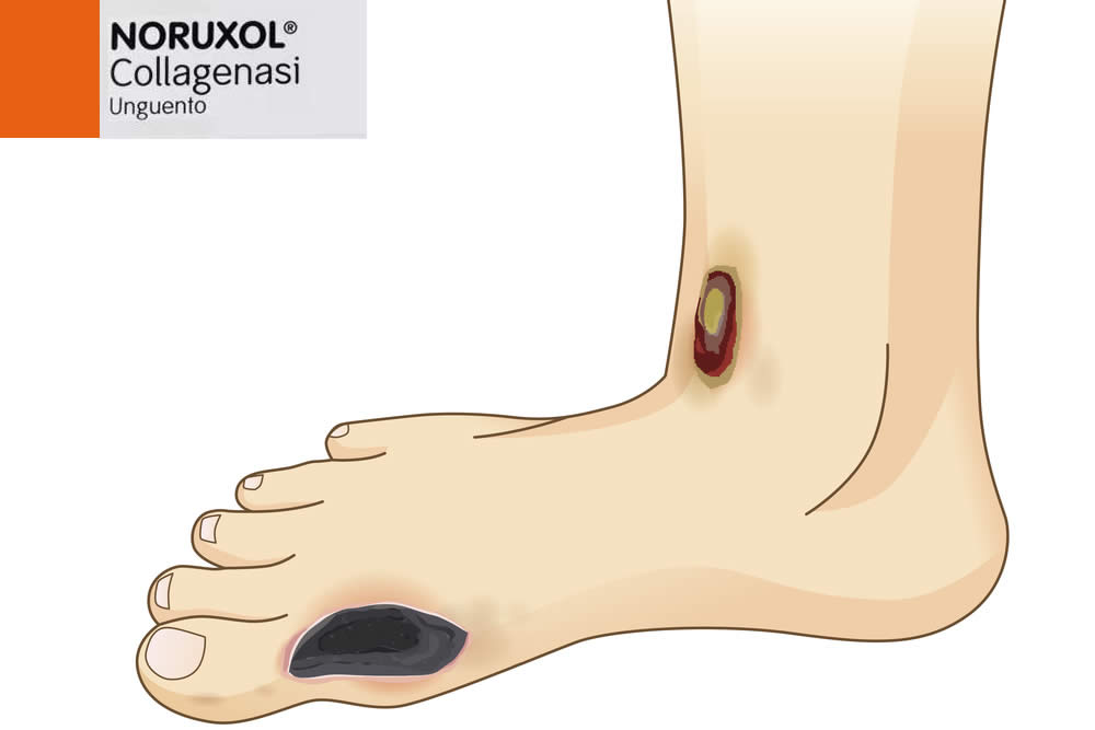 Noruxol 2019 - Unguento per Piaghe - Foglio Illustrativo Spiegato