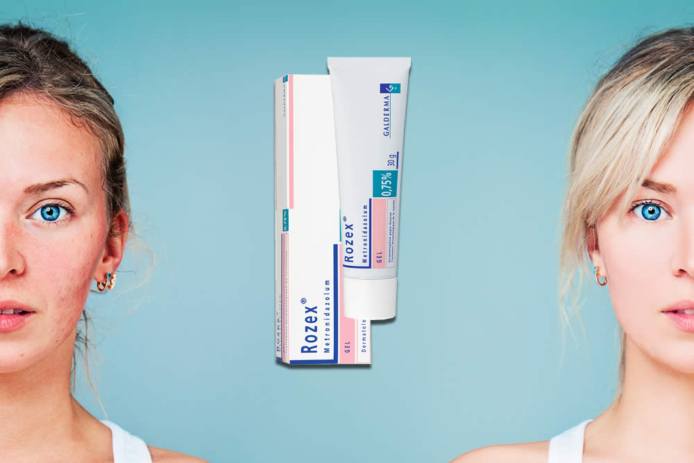 Rozex 2019 e Acne Rosacea - Uso, Prezzo e Foglio Illustrativo Spiegato