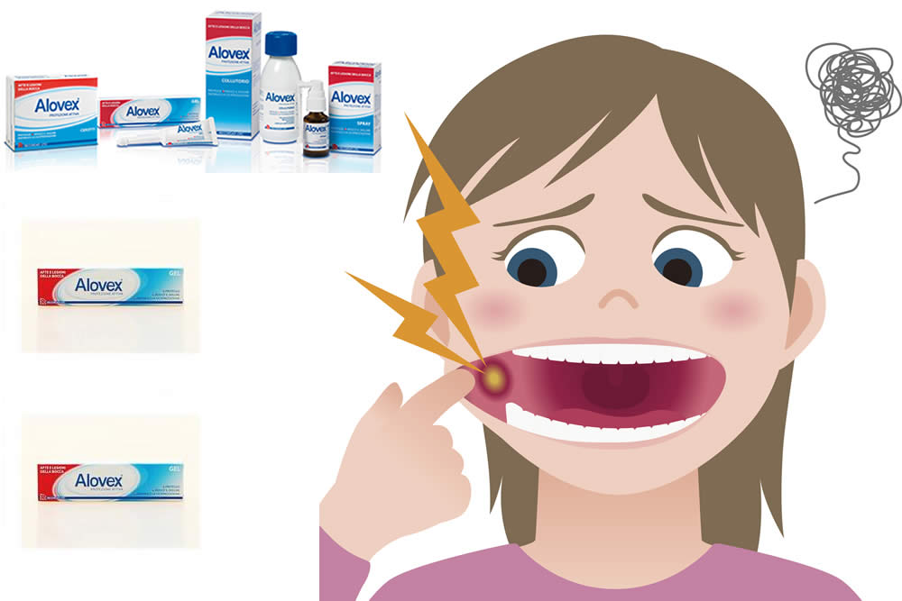 Alovex Gel 2019: Funziona contro le Afte? Come Agisce? Uso e Opinioni