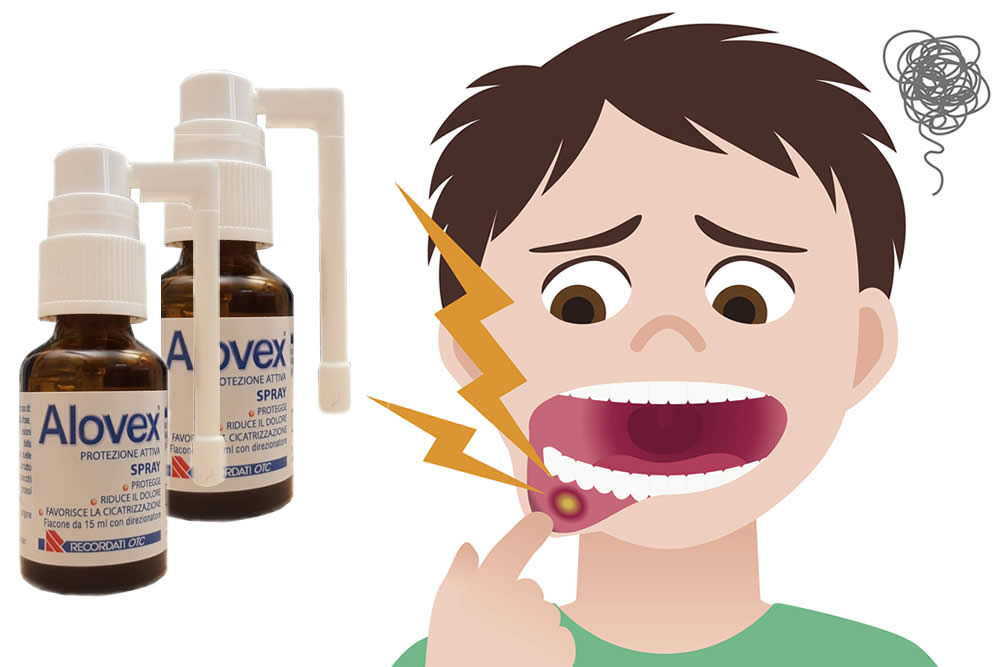 Alovex Spray 2019 e Afte della Bocca: Funziona? Uso, Benefici, Opinioni