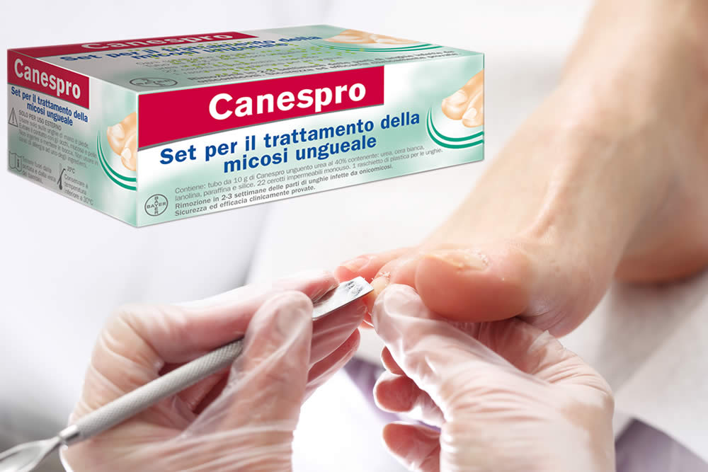 Canespro 2019 e Onicomicosi: Funziona? Fa Male? Uso e Opinioni
