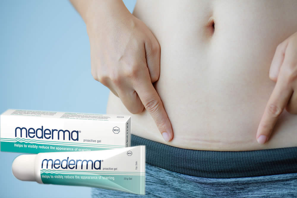 Mederma 2019 - Gel Trattamento Cicatrici: Funziona? Uso e Opinioni