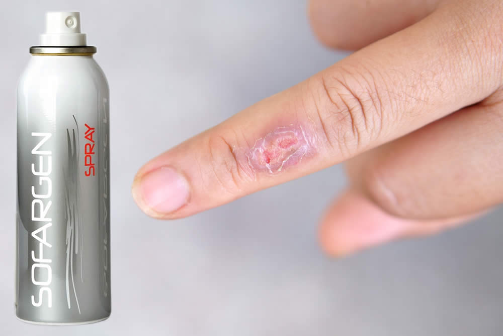 Sofargen Spray 2019: A Cosa Serve? Uso, Opinioni, Foglio Illustrativo