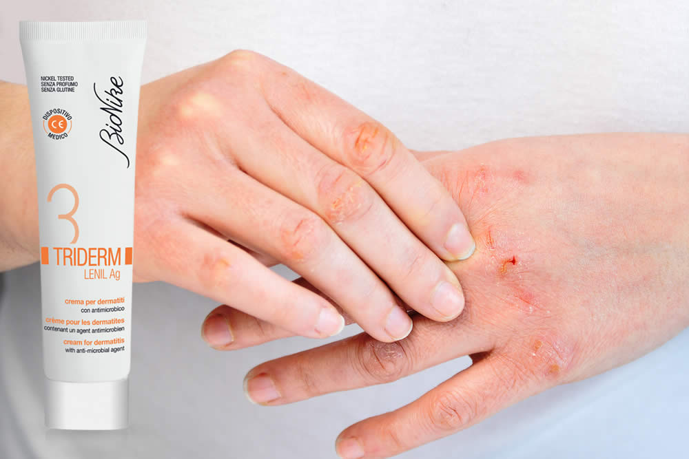 Triderm Lenil + Spiegato: Uso Contro la Dermatite, Prezzo e Opinioni